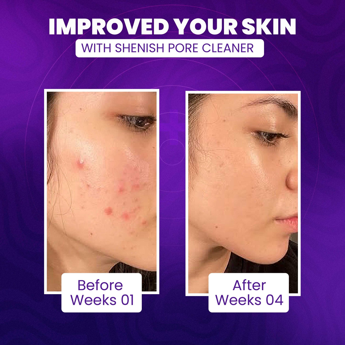 Imported™ Vacuum Pore Cleaner - Remove Blackheads Without Irritation or Redness